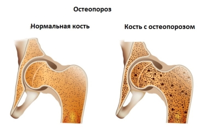 Этот сухофрукт предотвращает потерю костной массы и остеопороз: загадки чернослива